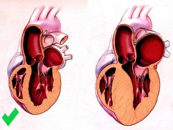 Cardione prevén a hipertrofia ventricular do corazón